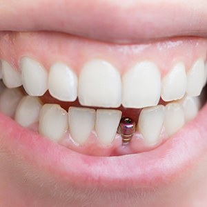 Close-up of unrestored dental implant in lower arch