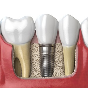 Illustration of dental implant with crown in jaw
