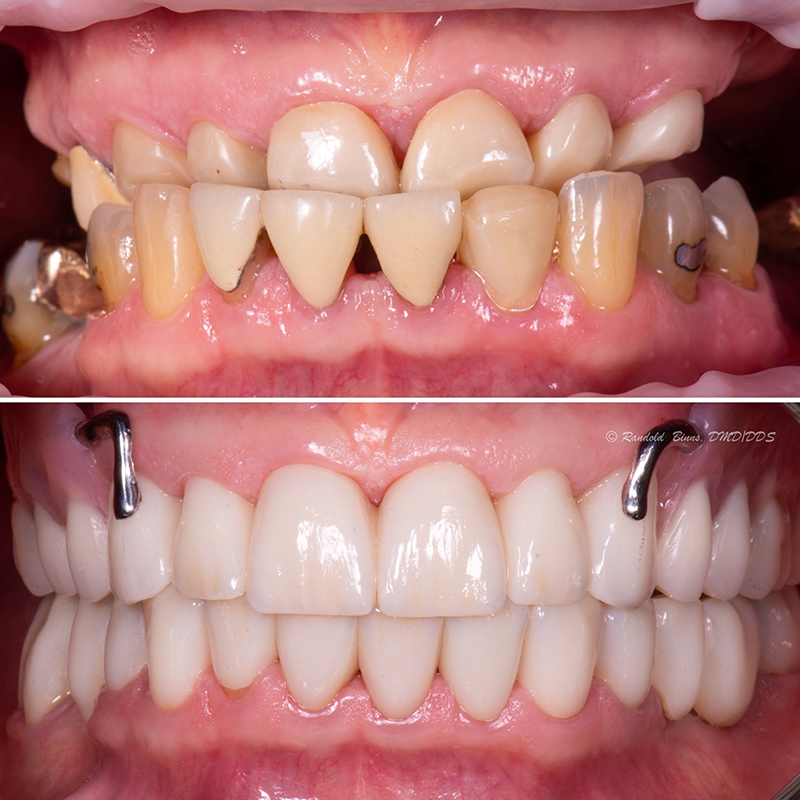 Bite Changed and Increased with Zirconia Crowns