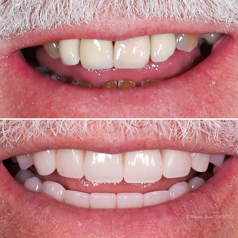 Denture and Implant Bridge smile