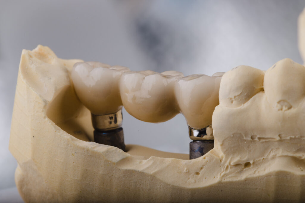 Implant-Supported Teeth: A Strong and Natural-Looking Solution for Missing Teeth